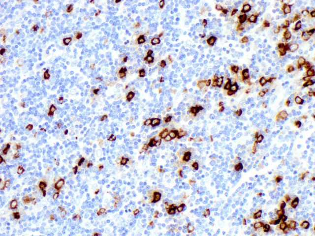 Lymph node biopsy shows that the neoplastic cells are positive for lysozyme (400x).